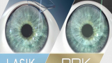 Phẫu thuật mắt bằng laser PRK là gì? nó khác gì so với LASIK?