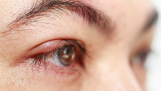 Dị ứng mắt: Nguyên nhân, triệu chứng và cách điều trị hiệu quả