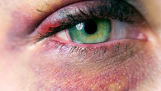 Mắt bầm tím là gì? Nguyên nhân, cách phòng ngừa và điều trị hiệu quả