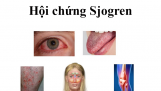 Hội chứng Sjogren là gì? Nguyên nhân và phương pháp điều trị