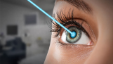 Hỏi đáp về điều chỉnh thị lực bằng phương pháp phẫu thuật LASIK