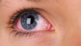 Hiện tượng đỏ mắt: Nguyên nhân và cách điều trị