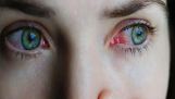 Một số câu hỏi thường gặp về tình trạng dị ứng mắt