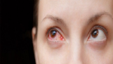 Bệnh đau mắt đỏ có thể lây truyền trong bao lâu?