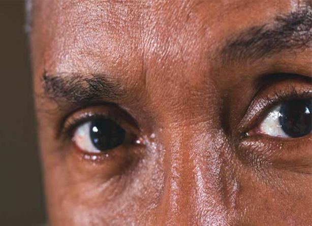 các bệnh lý đột quỵ mắt