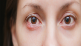 Bệnh chắp mắt là gì? Nguyên nhân và phương pháp điều trị