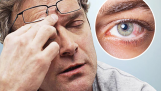 12 cách “thần kỳ” làm giảm chứng khô mắt hiệu quả mà bạn chưa biết