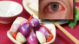 Bệnh đau mắt đỏ nên kiêng ăn gì?