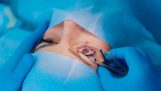 Phẫu thuật điều trị đục thủy tinh thể an toàn tại Hikari Eye Care